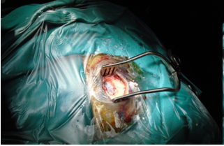 Chấn thương sọ não: máu tụ mạn tính