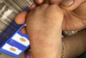 Cách chăm sóc trẻ bị tay-chân-miệng tại nhà