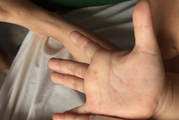 Bệnh chân – tay – miệng diễn biến nặng thời điểm giao mùa.