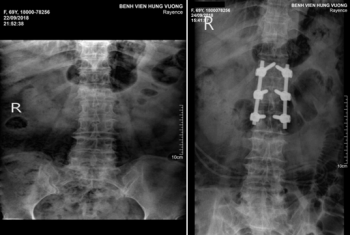 Chấn thương cột sống, vỡ đốt sống L1 do TNGT.