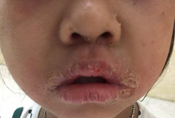 Bé gái bị mắc hội chứng bong vảy da do tụ cầu (hay còn gọi hội chứng 4S) bong chóc da toàn thân.