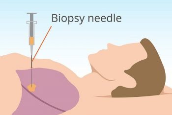 Thủ thuật sinh thiết tế bào