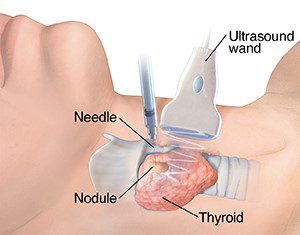 Thủ thuật chọc hút tế bào dưới hướng dẫn của siêu âm