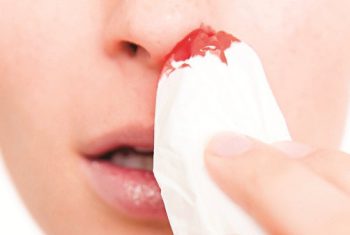 Đừng coi thường khi chảy máu mũi