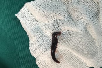 Uống nước suối, bị vắt chui vào mũi