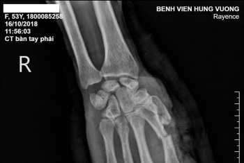 Biến dạng bàn tay do máy ép gạch bê tông.