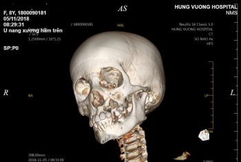 Phẫu thuật khối u nang xương hàm trên thành công cho bệnh nhi 8 tuổi.