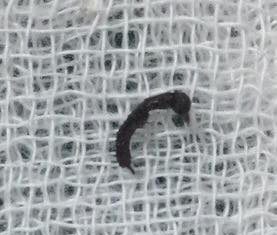 Gắp thành công chú kiến sống trong tai bệnh nhi 10 tuổi.