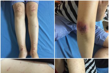 Xuất huyết dưới da toàn thân do mắc bệnh Viêm mao mạch dị ứng ( Henoch Schonlein)