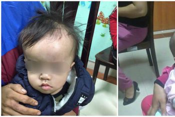 Đầu trẻ sơ sinh to lên bất thường – dấu hiệu căn bệnh nguy hiểm.