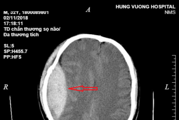 Cấp cứu: Phẫu thuật lấy máu tụ ngoài màng cứng cho bệnh nhân ngã từ độ cao 3m.