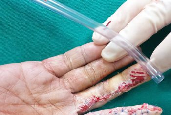 Lại thêm một vụ tai nạn lao động liên quan đến máy móc, cơ khí