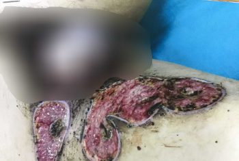 Nhiễm trùng, chảy mủ vết bỏng sau 20 ngày đắp lá thuốc nam.