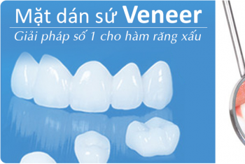 Tìm lại nụ cười tỏa sáng cho bệnh nhân 37 tuổi với răng sứ thẩm mỹ veneer.