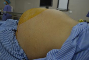 Khối u nhầy buồng trứng khổng lồ chiếm toàn bộ khoang bụng nữ bệnh nhân 61 tuổi.