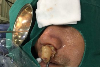 Phẫu thuật nội soi u mũi cho bệnh nhân 10 năm không thở được bằng đường mũi.
