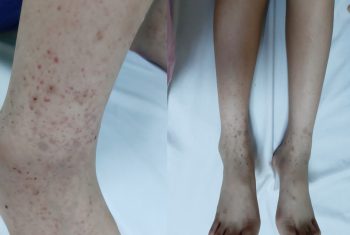 Ban xuất huyết henoch schonlein – Không nên coi thường