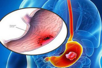 Cháu bé 12 tuổi đã mắc ung thư: BS cảnh báo căn bệnh ung thư khó phát hiện đang trẻ hoá