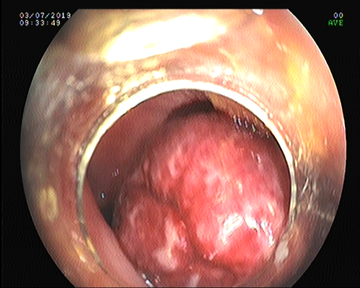 cap11