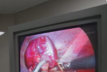Hy hữu nam bệnh nhân bị tăm đâm thủng ruột thừa.