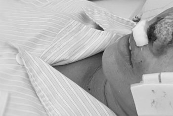 Bệnh Whitmore đột ngột tấn công nhiều người