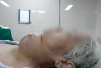 "Giải thoát" khối u tuyến giáp khổng lồ cho cụ bà 85 tuổi.