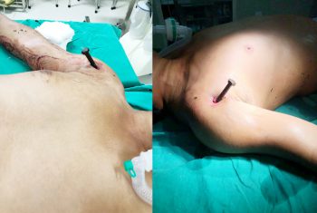 Ngã từ tầng 2, người đàn ông bị đinh găm thẳng vào vai phải