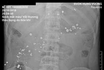 cấp cứu thành công nam BN bị súng tự chế bắn thủng 15 lỗ trên dạ dày trong khi đi rừng