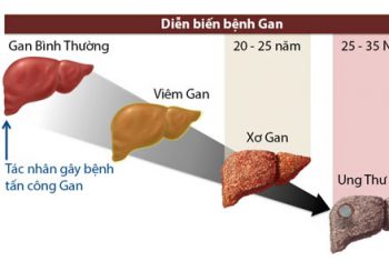 UNG THƯ TẾ BÀO GAN NGUYÊN PHÁT (HCC – Hepatocellular carcinoma)