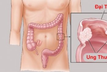 ĐI ngoài phân lỏng chớ chủ quan – có thể bạn đã mắc ung thư.