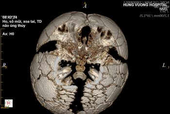 Cảnh báo bệnh loạn sản xương đòn, sọ cực hiếm gặp (Cleidocranial  Dysostosis)