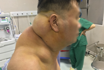 Nghiện rượu nhiều năm cơ thể nam bệnh nhân biến dạng như người khổng lồ