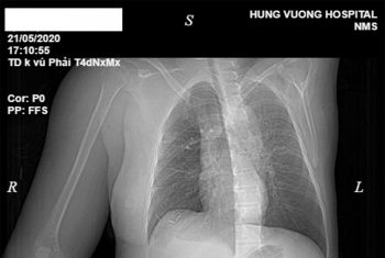 Đắp lá chữa ung thư: Bệnh nhân K vú di căn xương giai đoạn cuối