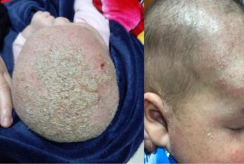 Viêm da tiết bã trẻ em