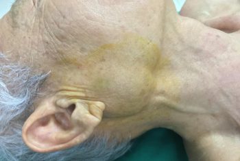 Phẫu thuật thành công u tuyến nước bọt mang tai bảo tồn dây thần kinh số VII