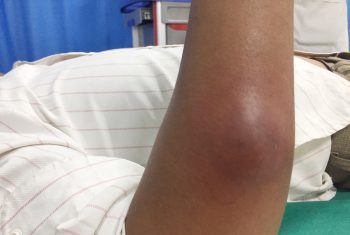 Cảnh báo: Mụn viêm gây áp xe – Tình trạng da nguy hiểm chớ coi thường