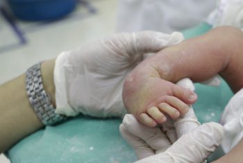 Phục hồi chức năng bàn chân khoèo bẩm sinh cho bé sơ sinh 10 ngày tuổi