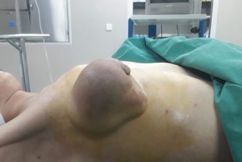 Phẫu thuật thành công u Phyllode tuyến vú đặc biệt
