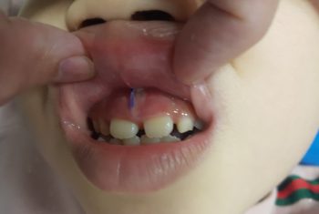 Lệch lạc răng và khớp cắn do phanh môi bám thấp ở trẻ em