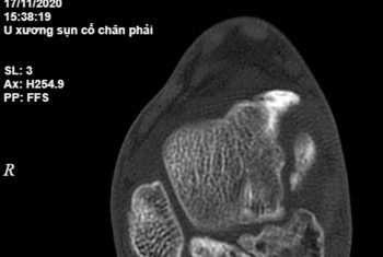 Phẫu thuật lấy bỏ gần 20 hạt sụn trong khớp cổ chân cho bệnh nhân 15 tuổi