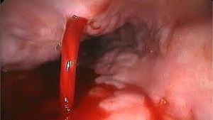 Tối cấp cứu,cứu sống bệnh nhân xuất huyết tiêu hóa, nôn ra máu do giãn vỡ tĩnh mạch thực quản