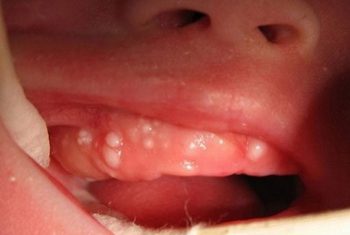 Nanh sữa ở trẻ: có nên nhể nanh?