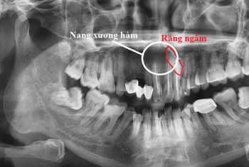 U lành tính vùng xương hàm: Nguyên nhân và điều trị