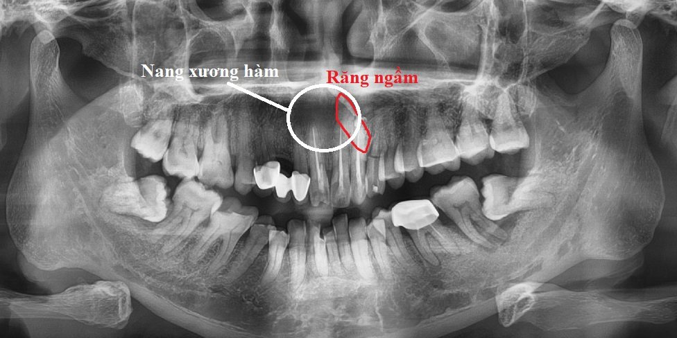 U lành tính vùng xương hàm: Nguyên nhân và điều trị - Bệnh Viện Đa ...