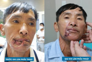 Phẫu thuật tạo hình vi phẫu chuyển vạt che khuyết hổng vùng đầu mặt cổ tại khoa Liên chuyên khoa – Bệnh viện đa khoa Hùng Vương