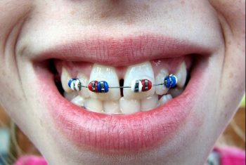 Răng cửa bị thưa phải làm sao để khít lại?