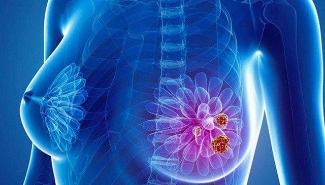 ung thư vú là gì