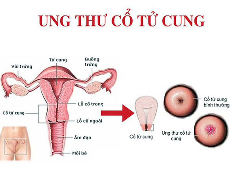 UNG THƯ CỔ TỬ CUNG LÀ GÌ? DẤU HIỆU NHẬN BIẾT