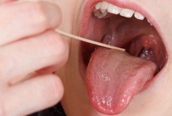 Dấu hiệu nhận biết ung thư lưỡi