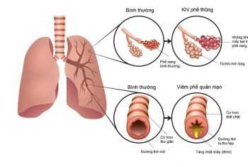 Bệnh phổi tắc nghẽn COPD và ung thư phổi